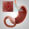 Gastrite, o erosione dello stomaco: i sintomi principali, il trattamento, la dieta