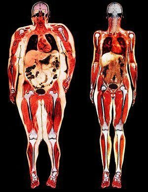 A sinistra - solo l'obesità viscerale. Tutti gli organi soffocato con grasso.