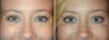 Quale combinazione di procedure cosmetiche si bombichesky effetto per il viso