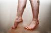 Violazione del flusso di sangue nelle gambe: cause, sintomi