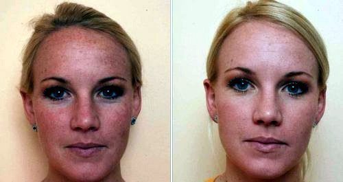Carbon peeling. Foto prima e dopo. Il paziente ha oleosa tipo di pelle.