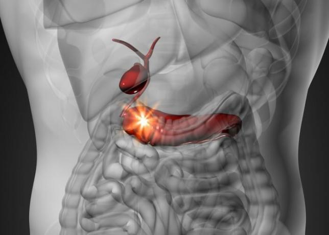 Il tumore al pancreas