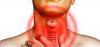 Tubercolosi della laringe: i primi segni di