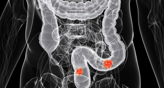 Il cancro intestinale - il cancro del colon