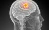 I sintomi di tumore al cervello incipiente