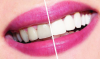 Come sbiancare i denti a casa? consulenza dentale.
