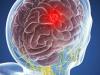 Tumore al cervello: 5 sintomi che non può essere ignorato