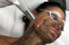 Laser peeling di carbonio: tutta la pelle problema porta all'ideale