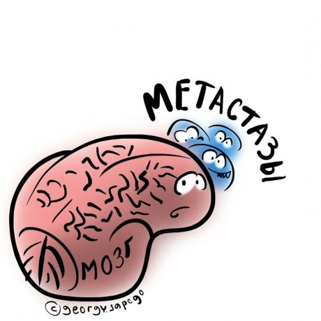 metastasi cerebrali
