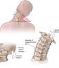 4 esercizi di base per la colonna vertebrale cervicale aiuteranno a dimenticare il dolore e osteocondrosi!