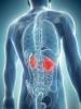 Il cancro del rene: i primi sintomi che dovrebbero mettere in guardia