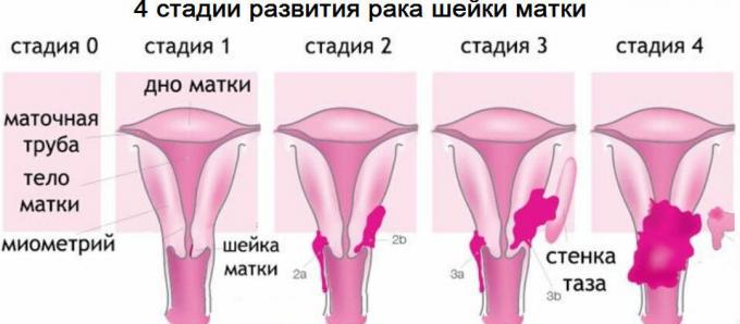 4 fasi del cancro del collo dell'utero