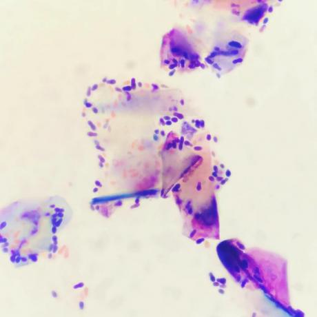 Il fungo Malassezia. molte varietà di dermatite ad esso associati. Ma questo è un argomento a parte per la discussione